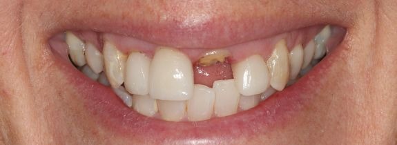 Immediate (same-day) implant
