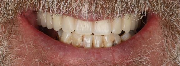 Upper All-on-4® implant bridge