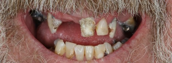 Upper All-on-4® implant bridge