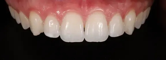 Invisalign®, Whitening, Bonding (1 tooth)