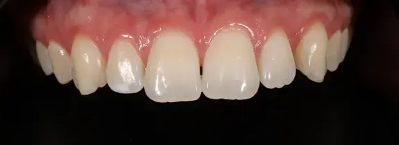 Invisalign®, Whitening, Bonding (1 tooth)