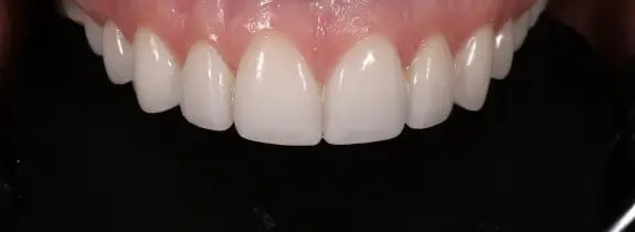 Porcelain veneers