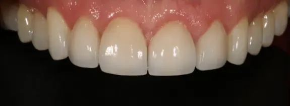 Porcelain Veneers, Crown Lengthening (by Dr Norcross) & Whitening