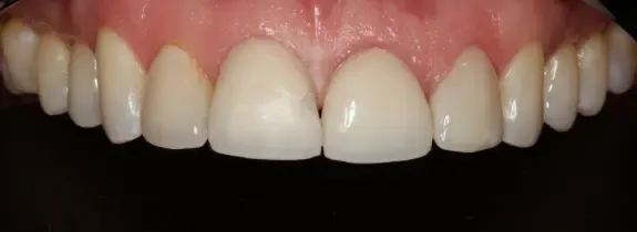 Porcelain Veneers, Crown Lengthening (by Dr Norcross) & Whitening