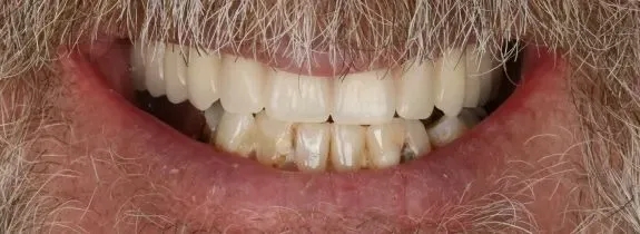 Upper All-on-4® implant bridge