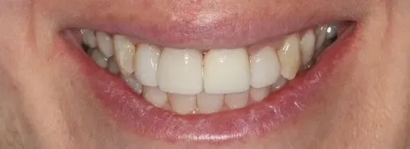 Immediate (same-day) implant