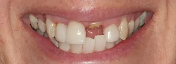 Immediate (same-day) implant