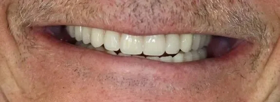 All-on-4® dental implants