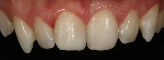 Bonding & Whitening (replaced old composite central upper tooth)