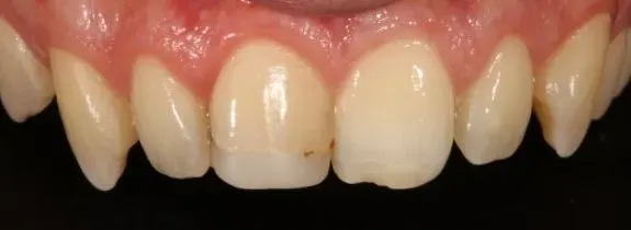 Bonding & Whitening (replaced old composite central upper tooth)
