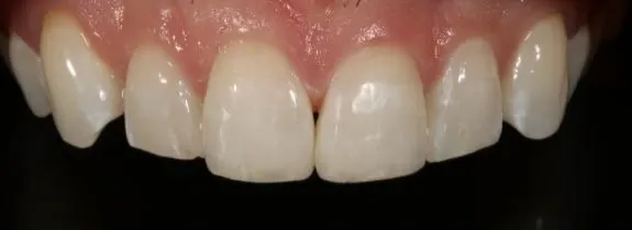 Composite Bonding