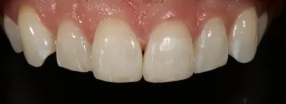 Composite Bonding