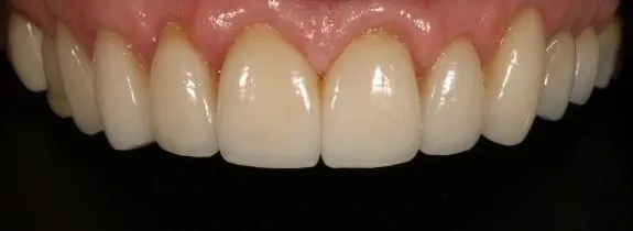 Crowns, Whitening