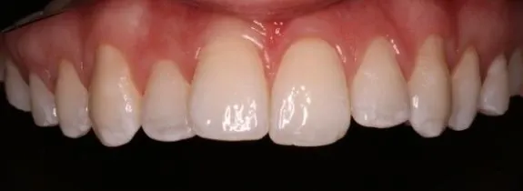 Invisalign®, Whitening, Bonding