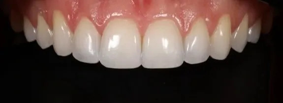 Invisalign® (top arch), Whitening, Bonding (1 tooth) and Recontouring