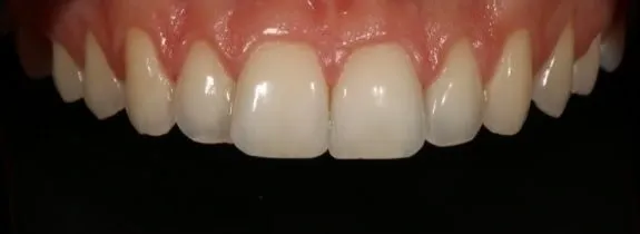 Invisalign® (top arch), Whitening, Bonding (1 tooth) and Recontouring