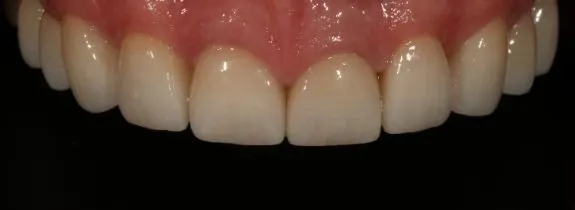 Crowns