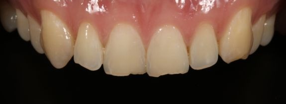 Whitening and Bonding