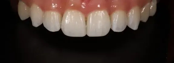 Invisalign, Whitening and 2 Composite Veneers