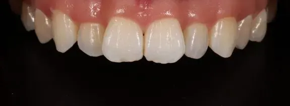 Invisalign, Whitening and 2 Composite Veneers