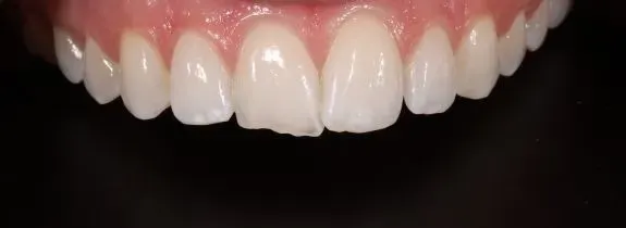 Invisalign, whitening and 1 composite veneer