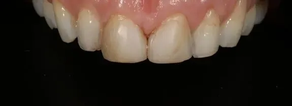 Porcelain Veneers, Crowns, Whitening & Bonding