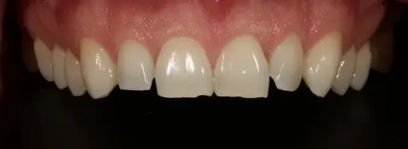Invisalign®, Whitening, Bonding