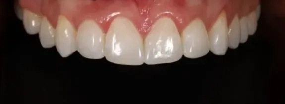 Invisalign®, Whitening, Bonding