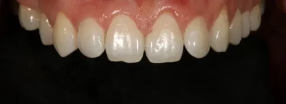 Invisalign®, Whitening, Bonding
