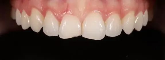 Bonding, Whitening and Gum lift