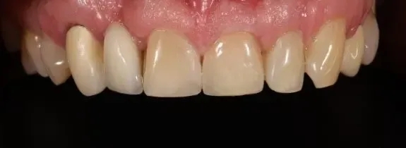 Crown and composite repair of bridge