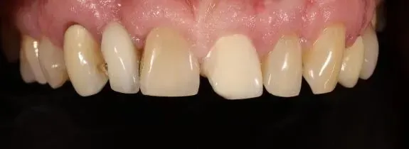 Crown and composite repair of bridge