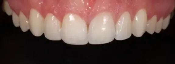 Invisalign®, Whitening, Bonding  (3 teeth) Gum Lift