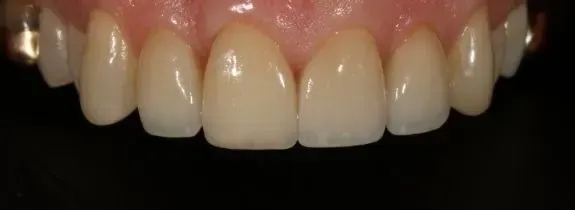Veneers, Crowns and Bonding