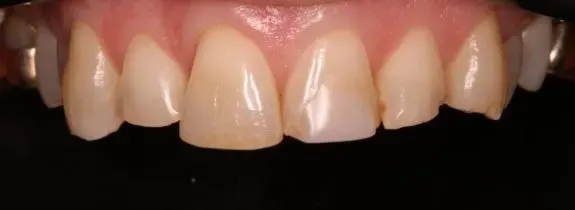 Veneers, Crowns and Bonding