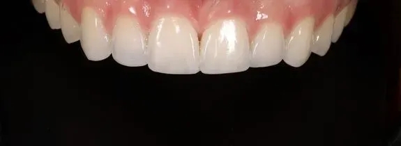 Whitening & Bonding (plus nightguard)