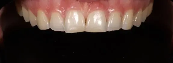 Whitening & Bonding (plus nightguard)