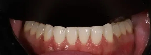 Composite Bonding (6 lower composites)