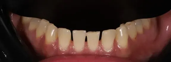 Composite Bonding (6 lower composites)