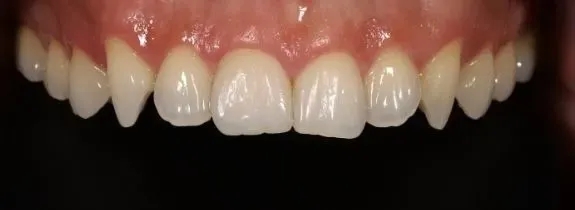 Crown and Teeth Whitening
