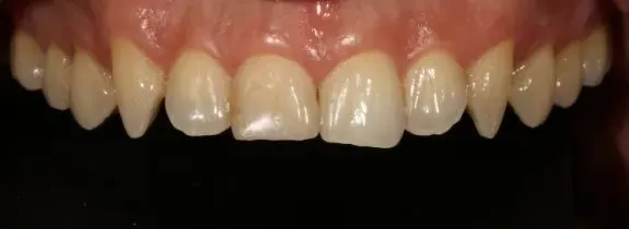 Crown and Teeth Whitening