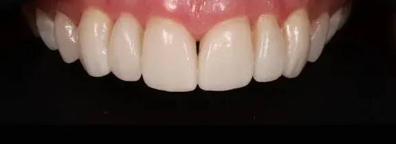 Porcelain veneers