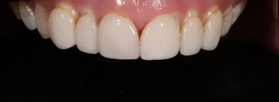 Porcelain veneers