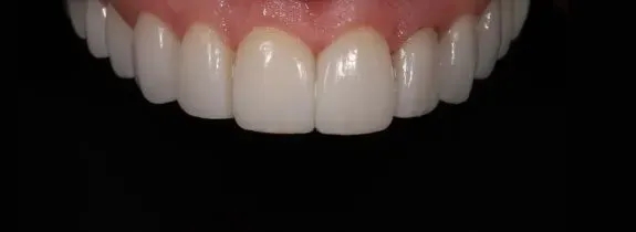 Porcelain veneers