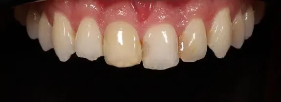 Composite Veneers & Whitening