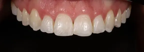 Composite Veneers, Whitening and Gum Lift