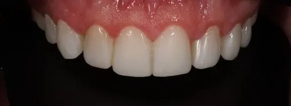 Composite Veneers Whitening and Gum Lift