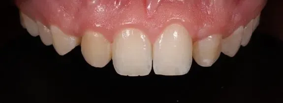 Composite Veneers Whitening and Gum Lift