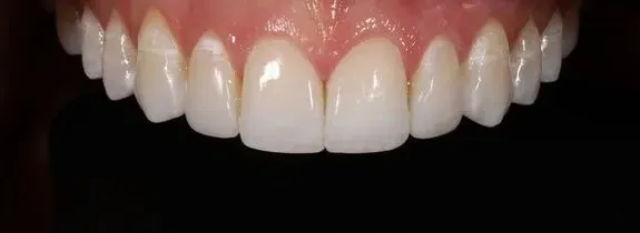 Composite Veneers & Whitening