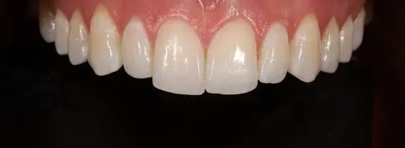 Composite Veneers & Whitening